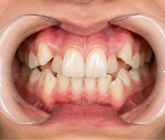 Antes del tratamiento de ortodoncia invisible: apiñamiento dental anterior — caso real de la Dra. Kelly Palacio en Bogotá