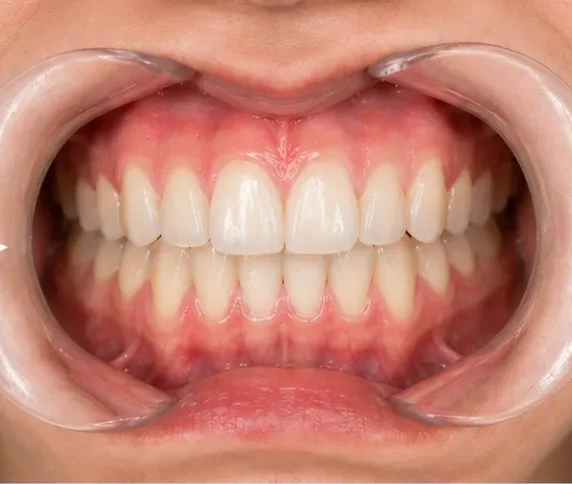 Después del tratamiento de ortodoncia invisible: dientes alineados — caso real de la Dra. Kelly Palacio en Bogotá