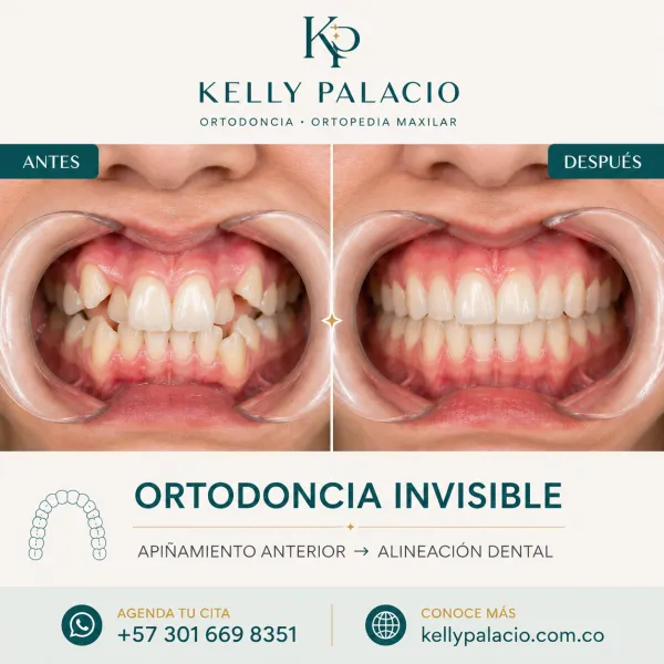 Caso real antes y después: Ortodoncia invisible — corrección de apiñamiento anterior. Apiñamiento anterior → Alineación dental armónica. Tratamiento realizado por la Dra. Kelly Palacio, ortodoncista en Bogotá.