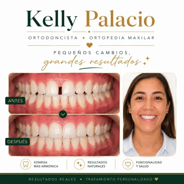 Caso real antes y después: Resultados naturales — sonrisa más armónica. Discromías y forma irregular → Sonrisa más armónica y funcional. Tratamiento realizado por la Dra. Kelly Palacio, ortodoncista en Bogotá.