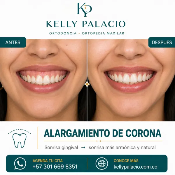 Caso real antes y después: Alargamiento de corona — sonrisa gingival. Sonrisa gingival → Sonrisa más armónica y natural. Tratamiento realizado por la Dra. Kelly Palacio, ortodoncista en Bogotá.