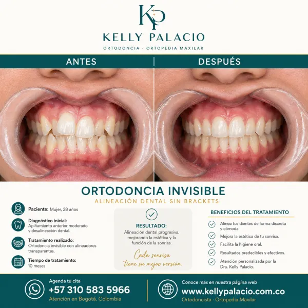 Caso real antes y después: Ortodoncia invisible en paciente adulta — 10 meses. Apiñamiento anterior moderado y desalineación dental → Alineación dental progresiva, estética y función. Tratamiento realizado por la Dra. Kelly Palacio, ortodoncista en Bogotá.