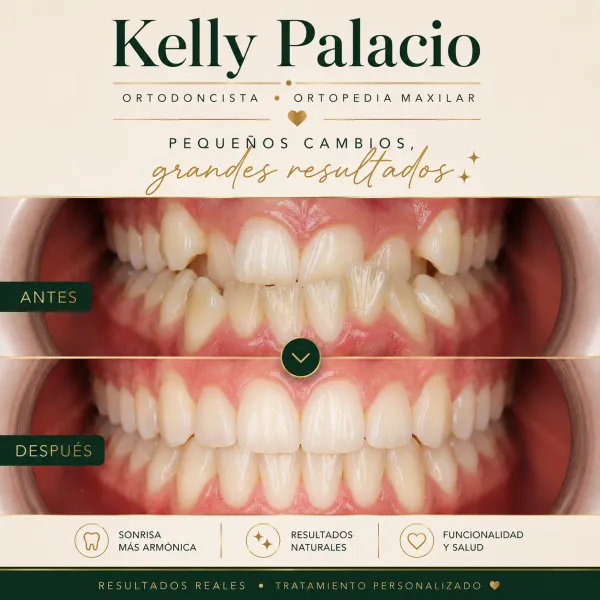 Caso real antes y después: Pequeños cambios, grandes resultados. Forma y posición irregular → Sonrisa armónica y funcional. Tratamiento realizado por la Dra. Kelly Palacio, ortodoncista en Bogotá.