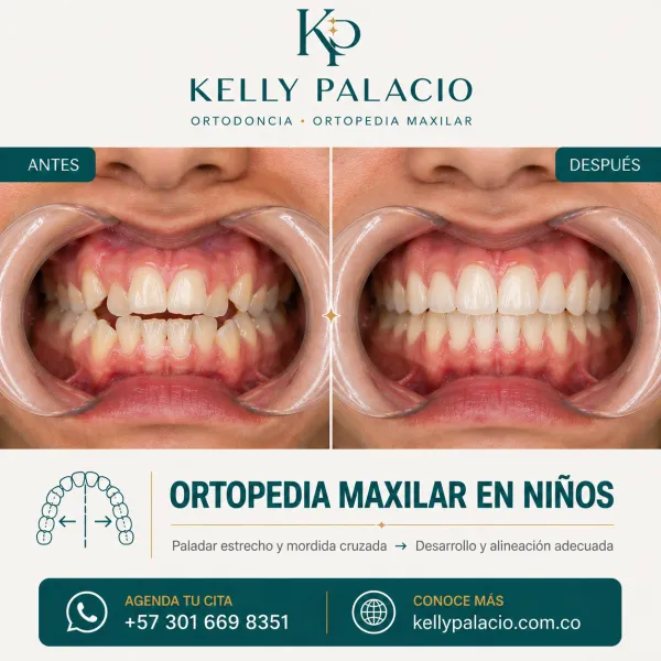 Caso real antes y después: Ortopedia maxilar en niños — paladar estrecho y mordida cruzada. Paladar estrecho y mordida cruzada → Desarrollo y alineación adecuada. Tratamiento realizado por la Dra. Kelly Palacio, ortodoncista en Bogotá.