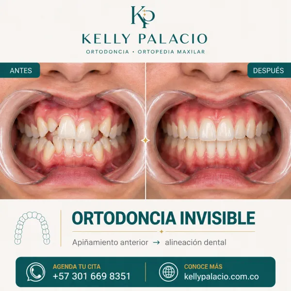 Caso real antes y después: Ortodoncia invisible — apiñamiento anterior. Apiñamiento anterior → Alineación dental. Tratamiento realizado por la Dra. Kelly Palacio, ortodoncista en Bogotá.