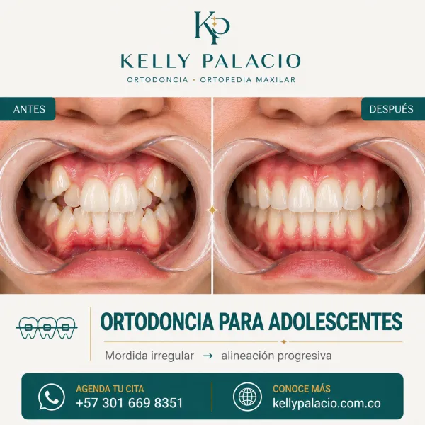 Caso real antes y después: Ortodoncia para adolescentes — mordida irregular. Mordida irregular → Alineación progresiva. Tratamiento realizado por la Dra. Kelly Palacio, ortodoncista en Bogotá.