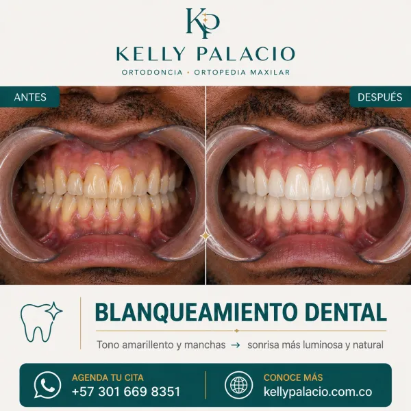 Caso real antes y después: Blanqueamiento dental — sonrisa más luminosa. Tono amarillento y manchas → Sonrisa más luminosa y natural. Tratamiento realizado por la Dra. Kelly Palacio, ortodoncista en Bogotá.