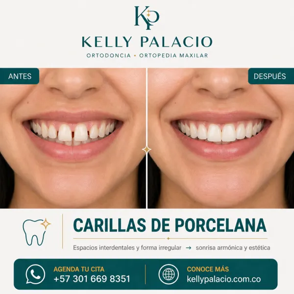 Caso real antes y después: Carillas de porcelana — cierre de espacios interdentales. Espacios interdentales y forma irregular → Sonrisa armónica y estética. Tratamiento realizado por la Dra. Kelly Palacio, ortodoncista en Bogotá.